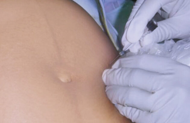 Amniocentesis Diagnóstica